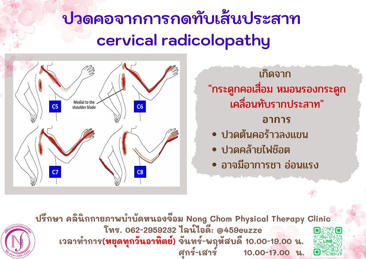 ตำแหน่งอาการปวดคอ C5-C8