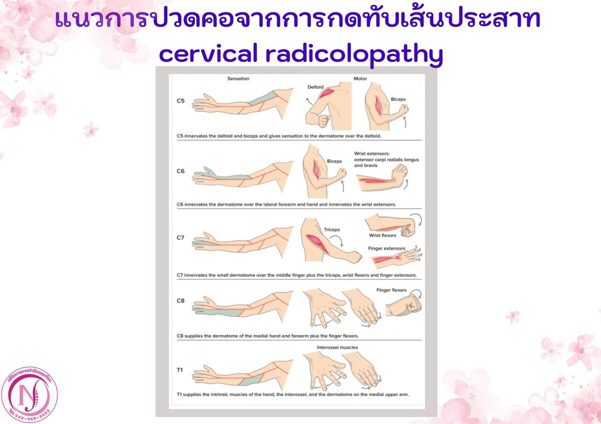 แนวการปวดคอตามรากประสาท C5-T1