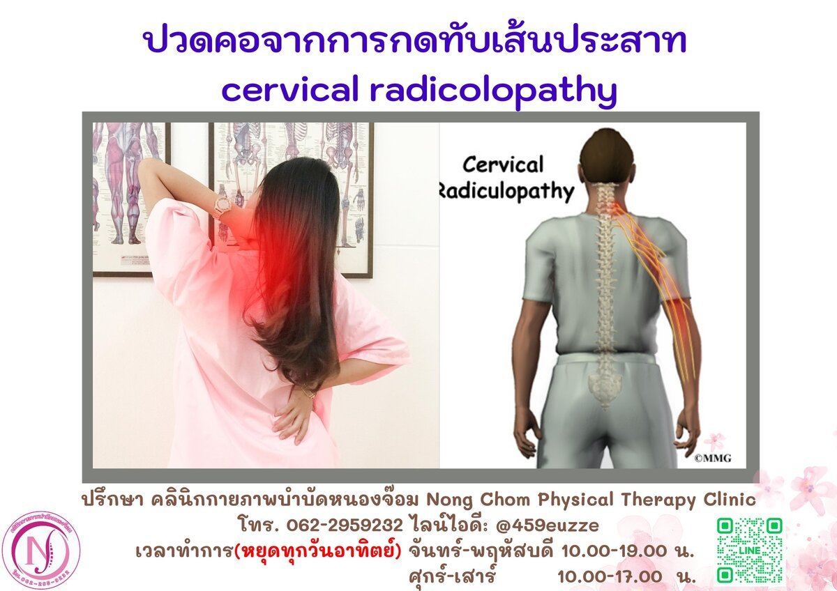 Cervical Radiculopathy