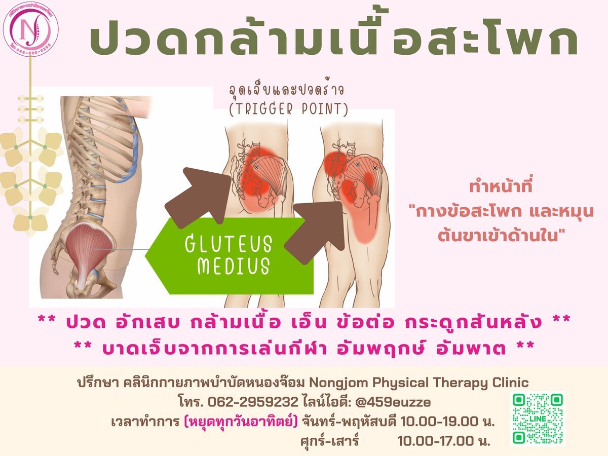 จุดปวดร้าว Gluteus Medius