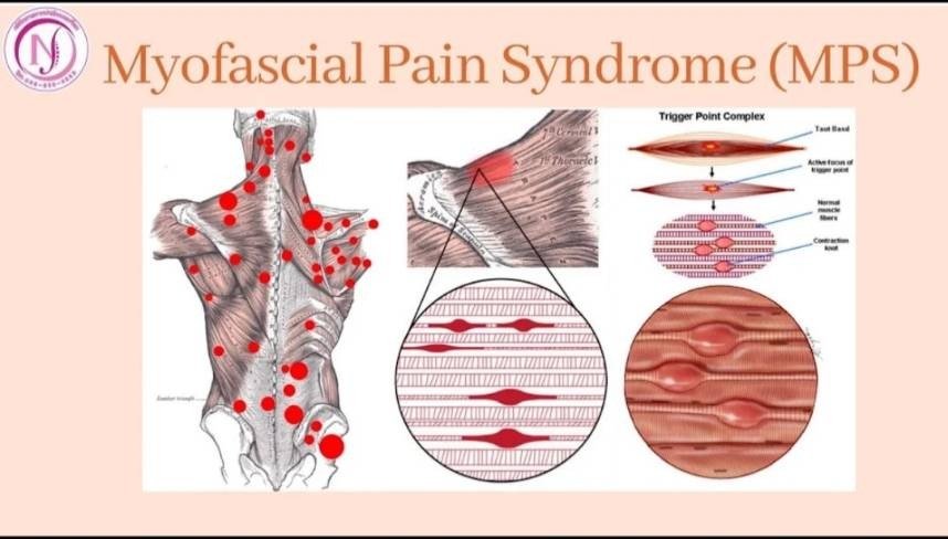 Myofascial Pain Syndrome