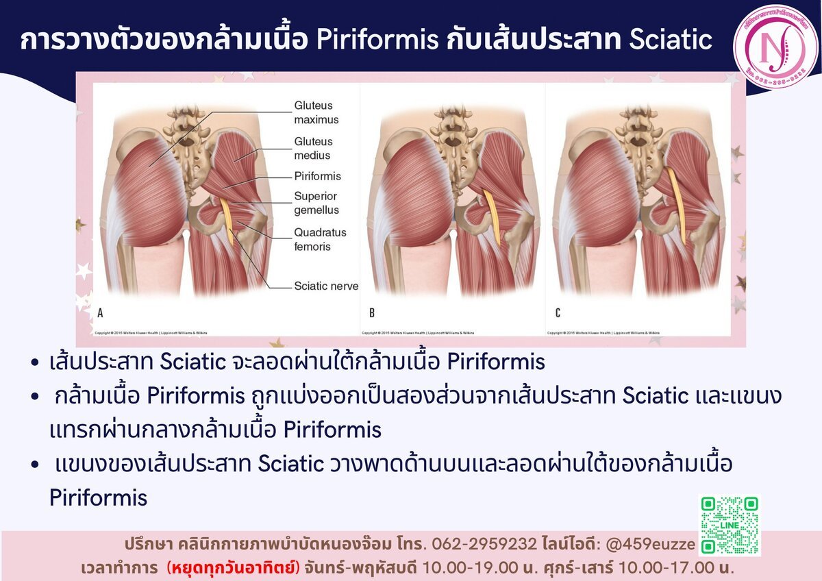 กล้ามเนื้อ Piriformis กับเส้นประสาท Sciatic